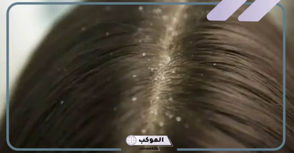 تفسير حلم القمل في الشعر للعزباء وهل له علاقة بالتقوى؟ 6 تفسير حلم القمل في الشعر وقتله للعزباء