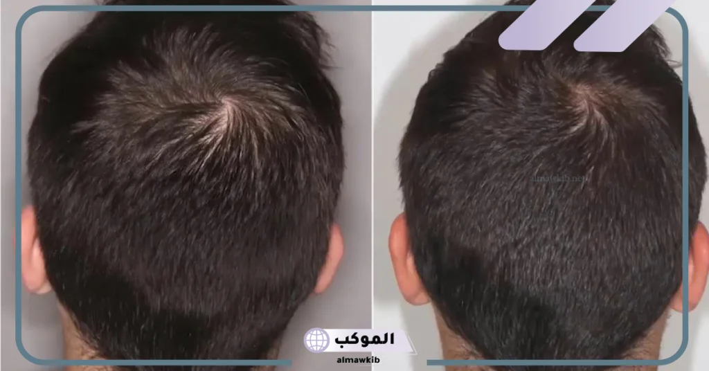 تجربتي مع الريجينيرا لعلاج الصلع الوراثي 5 تجربتي مع الريجينيرا لعلاج الصلع الوراثي