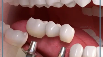 تلبيسة الزيركون