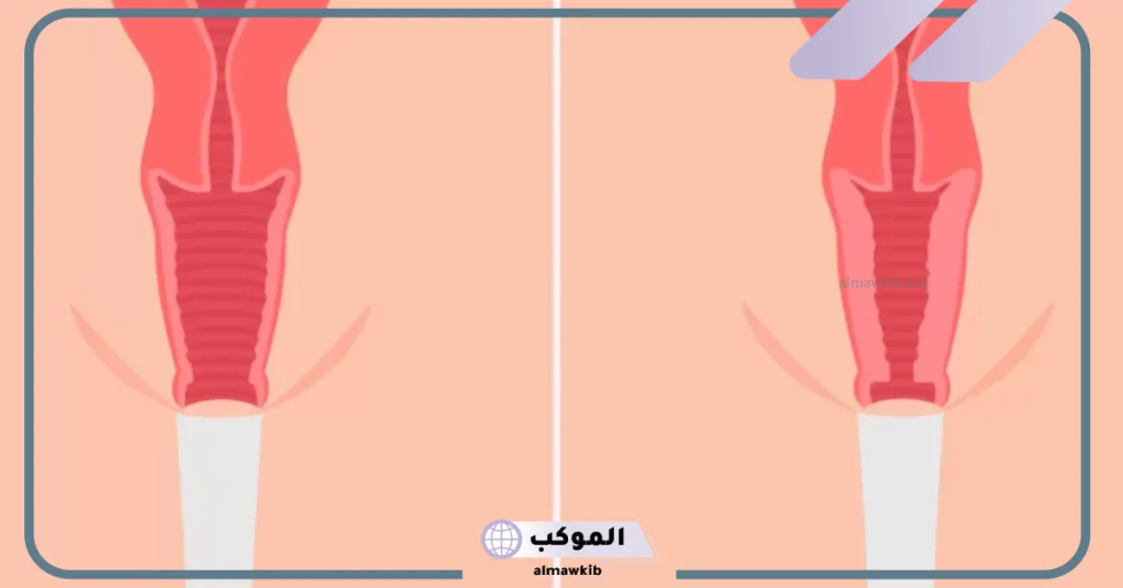 تجربتي مع عملية تضييق المهبل جراحيا بعد الولادة القيصرية 6 تضييق المهبل بعد الولادة بالأعشاب