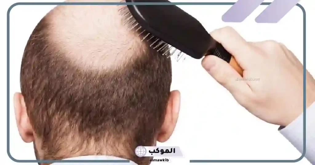 تفسير حلم الصلع في جزء من الراس لابن سيرين