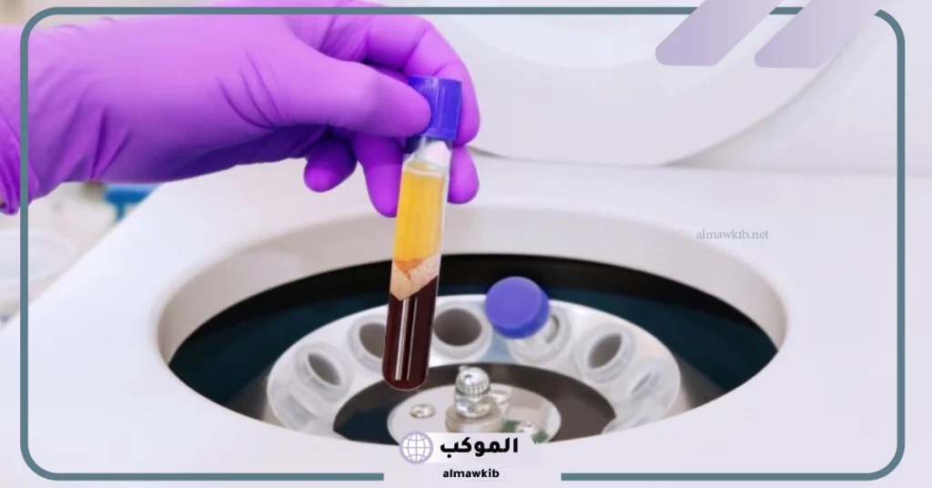 طريقة حقن البلازما للشعر  