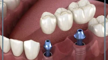 حلم وقوع الاسنان