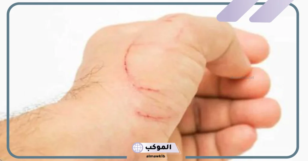 رؤية الخدوش في المنام لابن سيرين للمتزوجة 6 تفسير حلم شخص يخدشني للمتزوجه