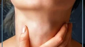 خطورة سرطان الغدد الليمفاوية