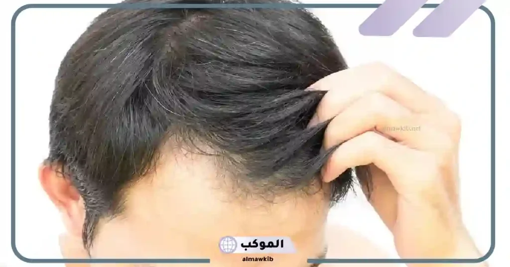 تفسير حلم الصلع في جزء من الشعر للمتزوجه