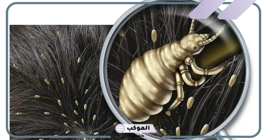 تفسير حلم القمل في الشعر للعزباء وهل له علاقة بالتقوى؟ 5 تفسير حلم القمل في الشعر وقتله للعزباء