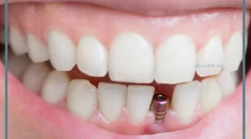 زراعة الأسنان