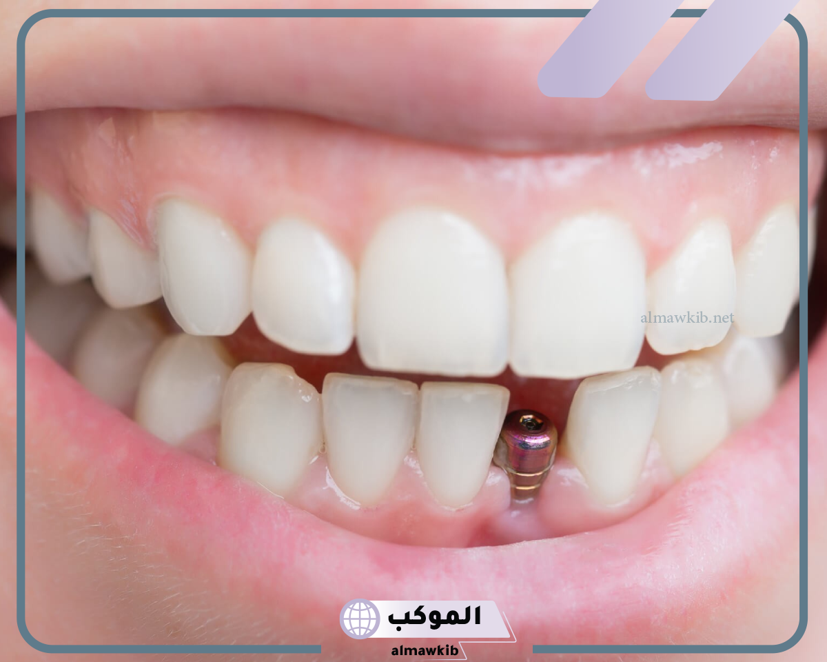 تجربتي مع زراعة الأسنان