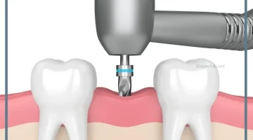 زراعة العظام الفكية