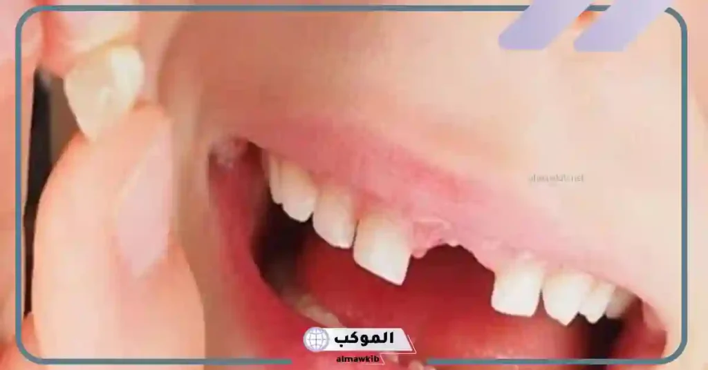 سقوط الأسنان في المنام للمتزوجة