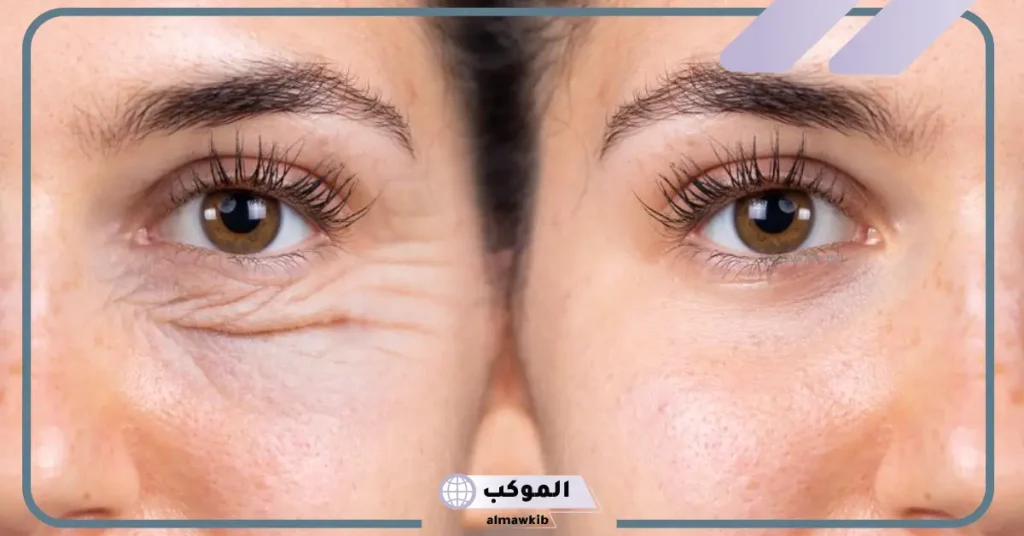تجربتي مع عملية شد الجفون وأحدث طرق العلاج 5 علامات فشل عملية شد الجفون