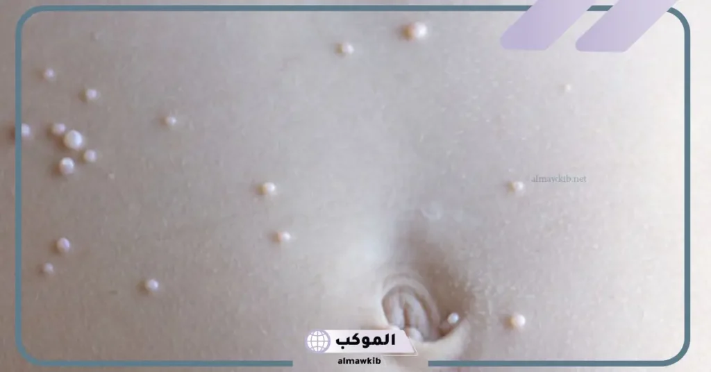 تجربتي مع المليساء المعدية بالأسباب والأعراض 5 علاج المليساء المعدية في الوجه