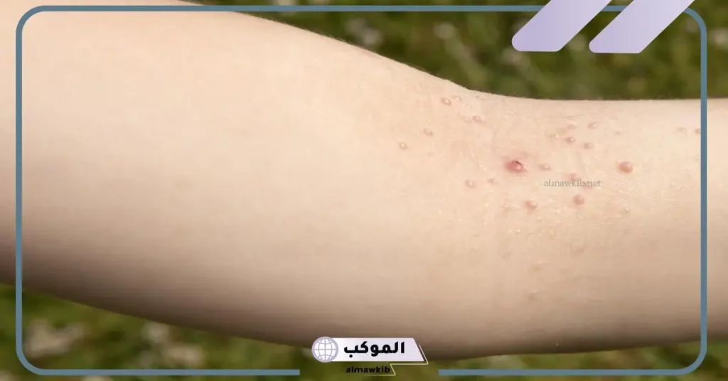 تجربتي مع المليساء المعدية بالأسباب والأعراض 6 علاج المليساء المعدية عند الأطفال