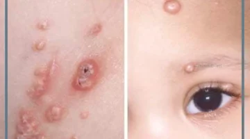 علاج المليساء بالليزر