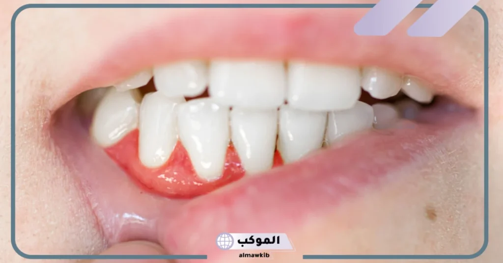 تجربتي مع انحسار اللثة عالم حواء