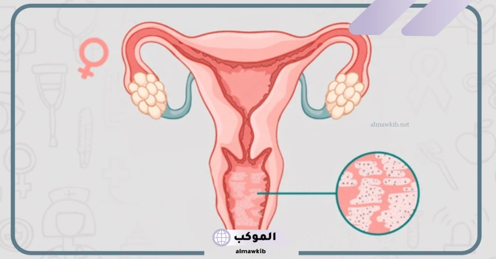 تجربتي مع فطريات المهبل والعلاج النهائي 6 علاج فطريات المهبل المتكررة