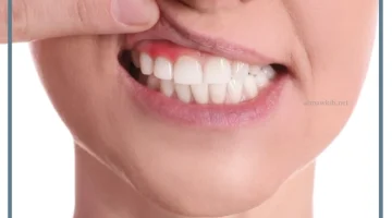 علاجات طبيعية لانحسار اللثة