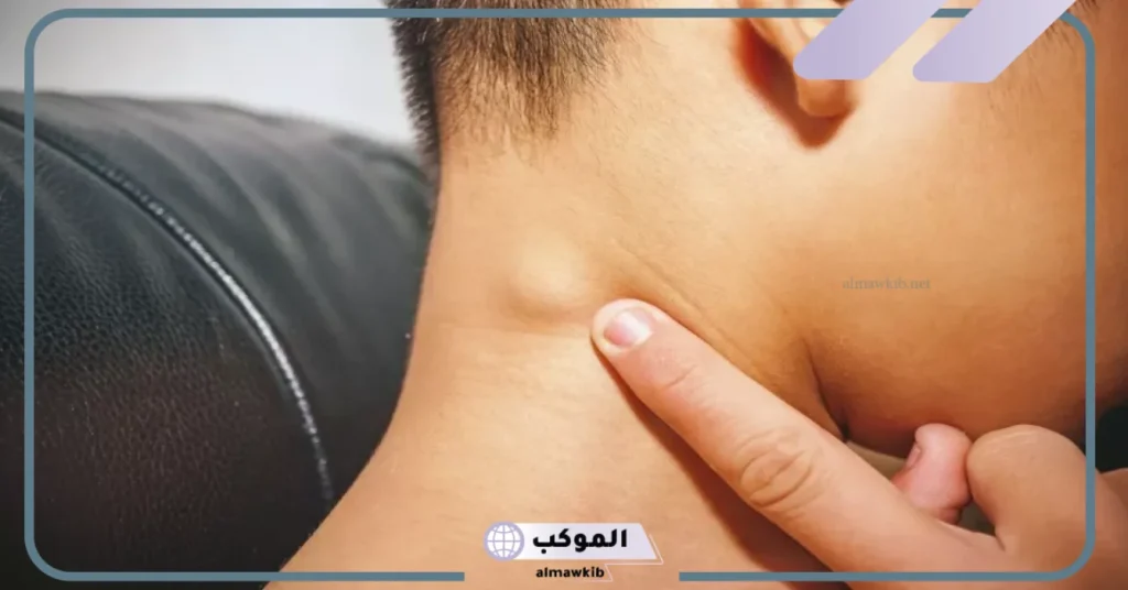 هل سرطان الغدد اللمفاوية خطير