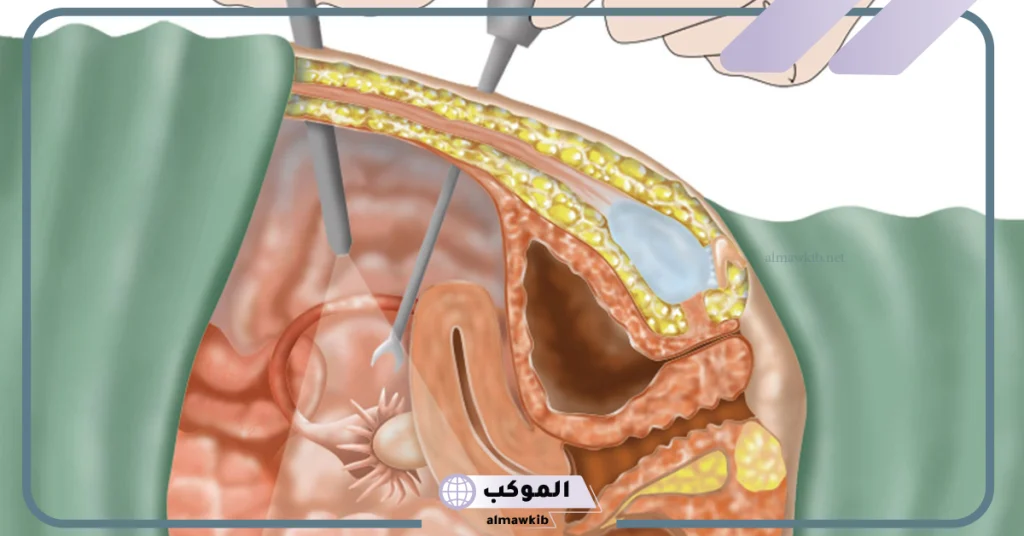 تجربتي مع عملية تضييق المهبل جراحيا بعد الولادة القيصرية 5 عملية تضييق المهبل بعد الولادة الطبيعية