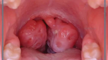 عملية اللوز