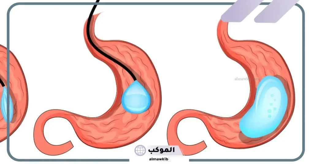 مميزات وعيوب بالون المعدة