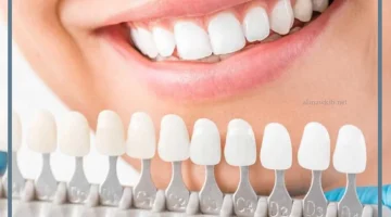 عيوب جسور الأسنان