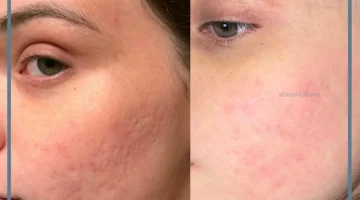 فراكشنال ليزر للوجه