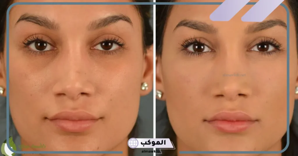 أفضل نوع فيلر تحت العين