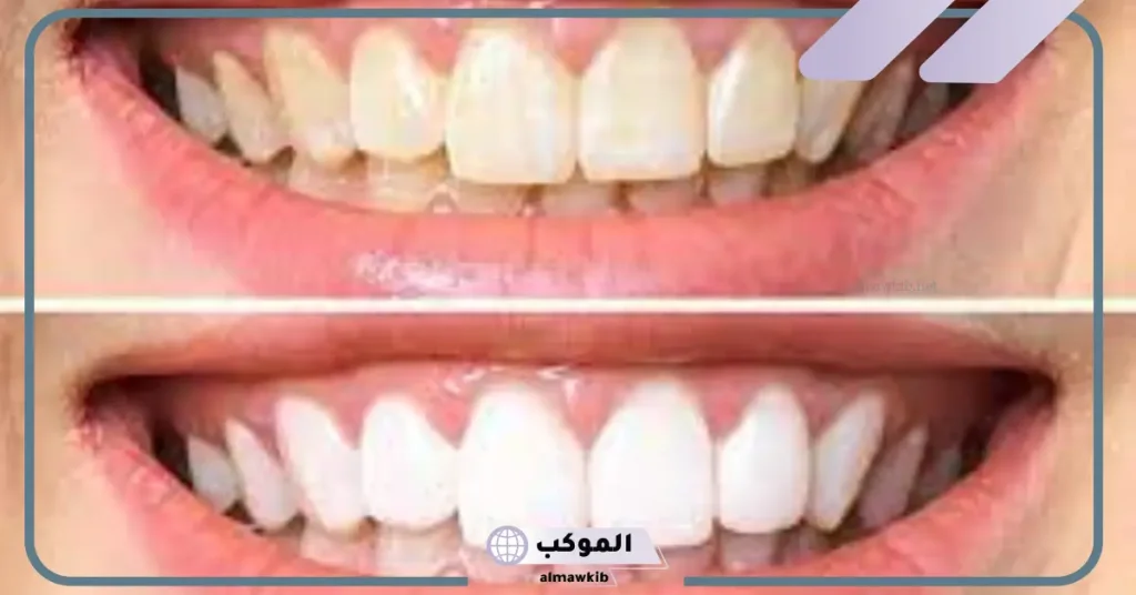 تجربتي مع معجون ديبوردنت لتبييض الأسنان 6 معجون ديبوردنت طريقة استخدام
