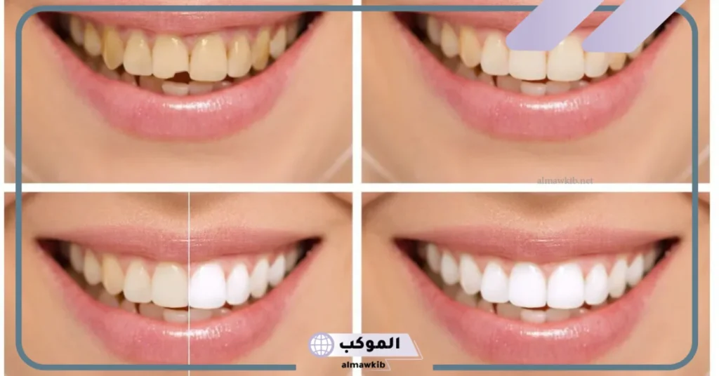 تجربتي مع عدسات الاسنان وأبرز النتائج بالفوائد والأضرار 5 تجربتي مع الدايركت فينير