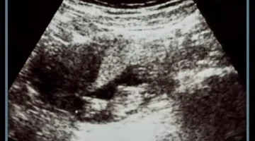 كيس الحمل بدون جنين