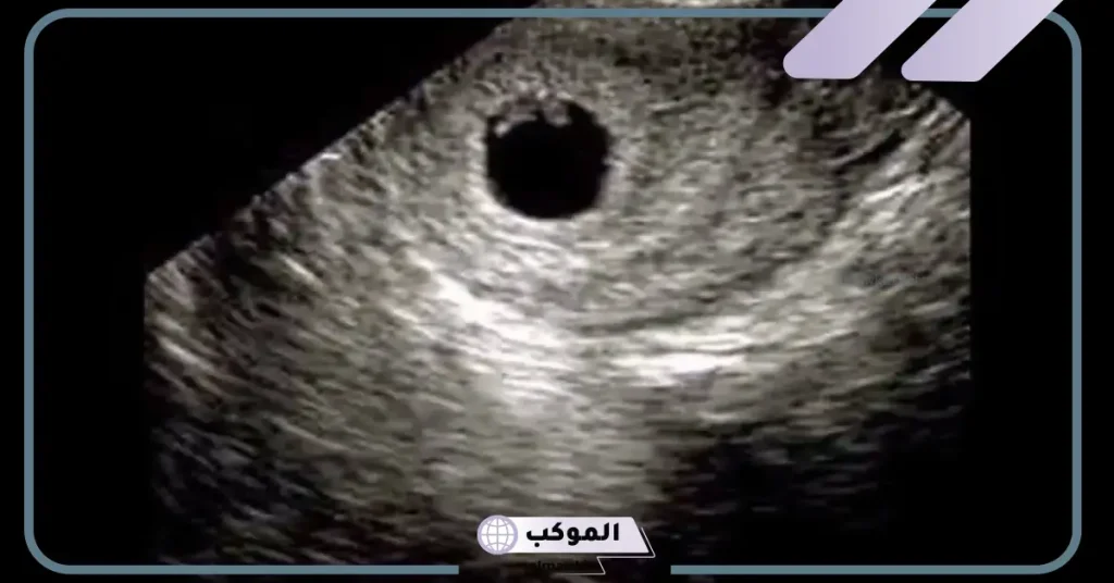 تجربتي مع الحمل بكيس بدون جنين وطرق العلاج والأسباب 6 كيف أعرف أن كيس الحمل في جنين؟