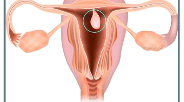 لحمية الرحم