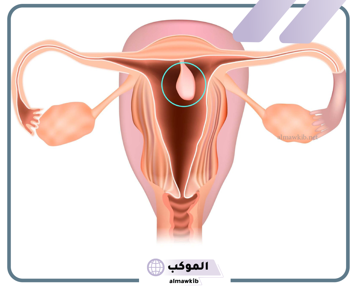 تجربتي مع لحمية الرحم والحمل