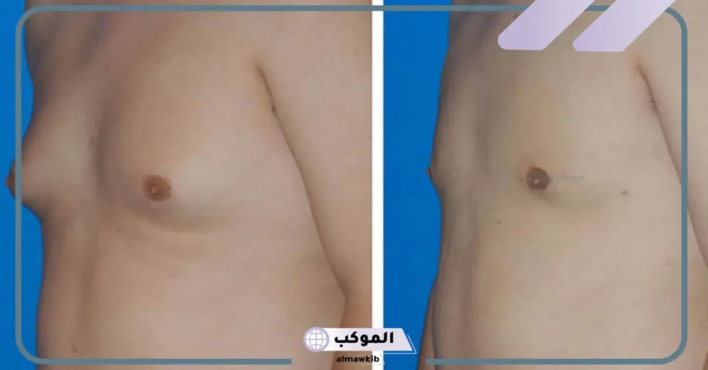 فشل عملية التثدي