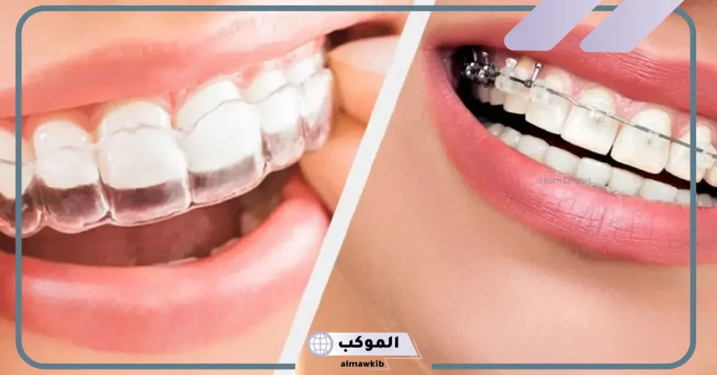 تجربتي مع التقويم الشفاف والنتيجة.. مدة لبس التقويم الشفاف  6 هل التقويم الشفاف يعالج بروز الأسنان