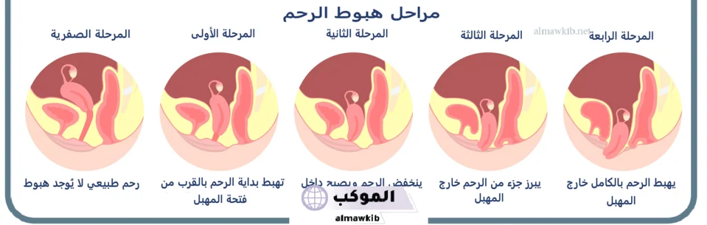 تجربتي مع نزول الرحم بالأسباب والأعراض 6 أسباب هبوط الرحم