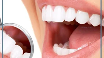نصائح للحفاظ على عدسات الأسنان