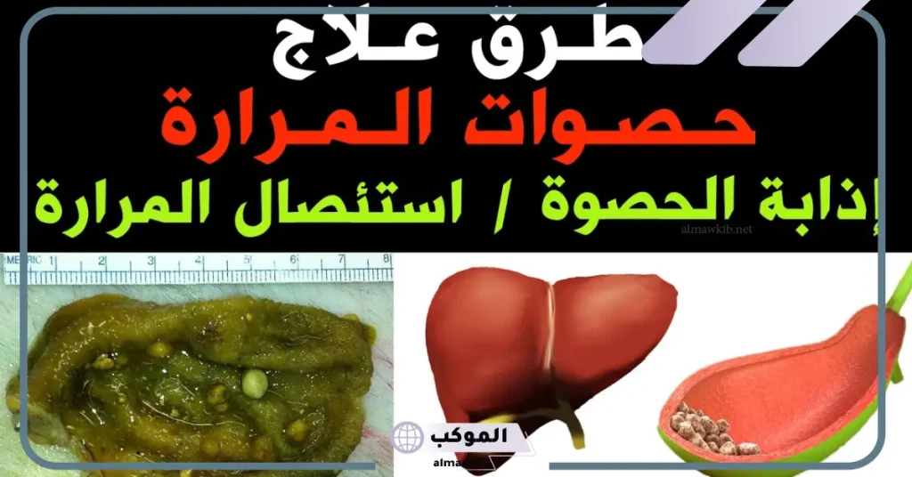 كيفية التخلص من حصوات المرارة في يوم واحد بإذن الله من الطب البديل 5 أسهل طريقة لعلاج حصوة المرارة بدون جراحة