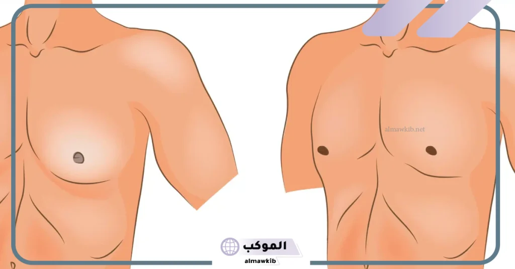 كيفية التخلص من التثدي عند الرجال في أسبوع.. أسباب التثدي 5 طريقة سهلة للتخلص من بروز الثدي عند الرجال
