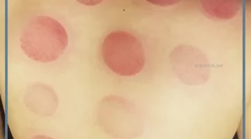 الحجامة للعين