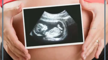 الحقن المجهري للحمل بولد