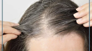 الشيب المبكر