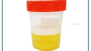 بروتين في البول