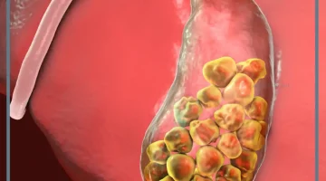 حصوات المرارة