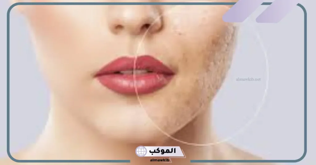 نصائح بعد الهيدرا فيشل