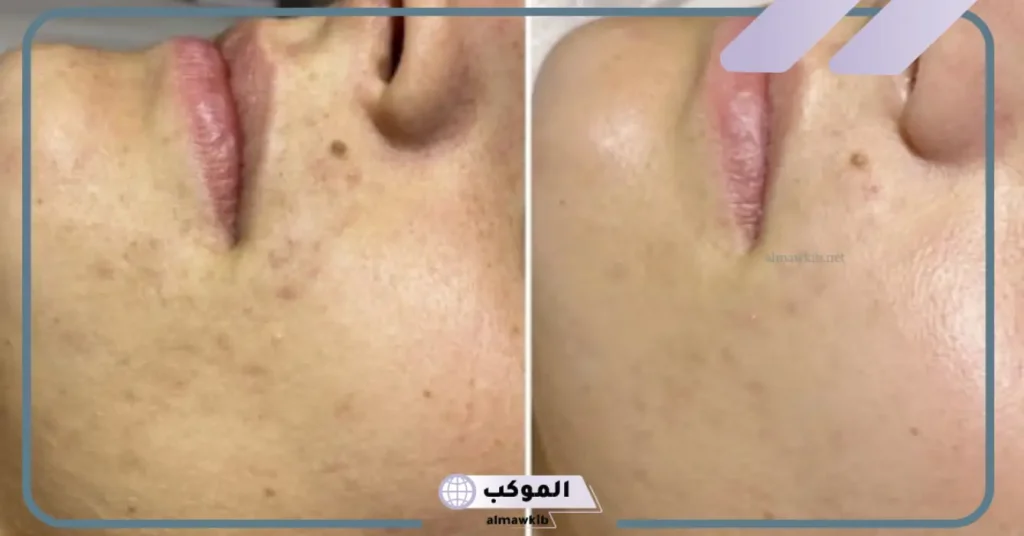 اضرار الهيدرا فيشل