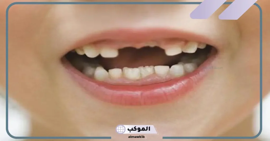 حلمت سني طاح في المنام لابن سيرين وسقوط السن للعزباء 5 سقوط الأسنان في المنام للمتزوجة