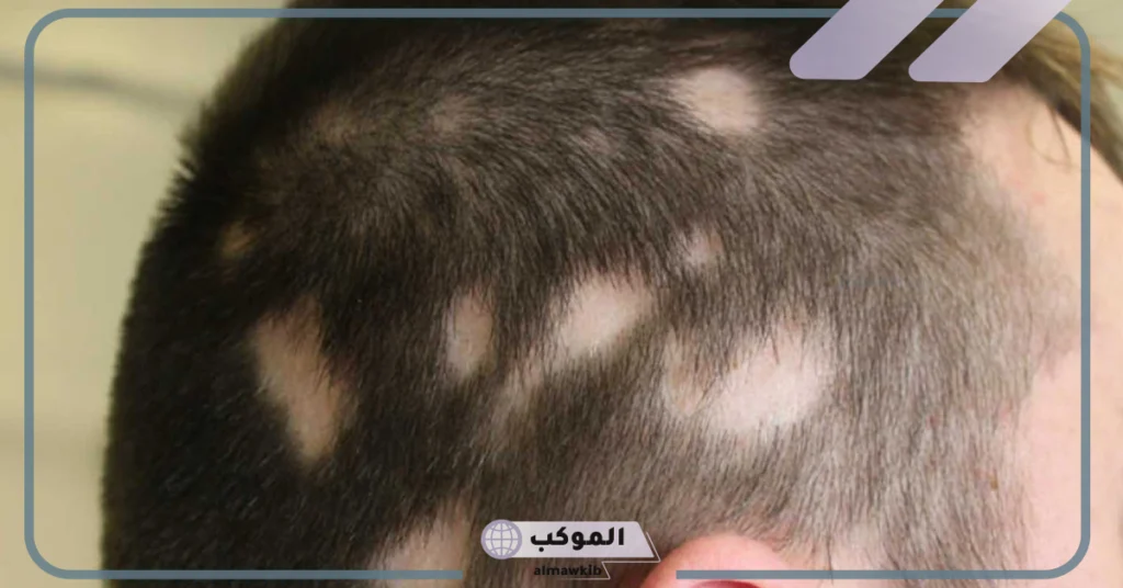 تفسير حلم الثعلبة في الشعر للعزباء 